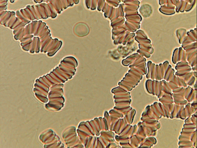 2. Překyselení - zlepene erytrocyty